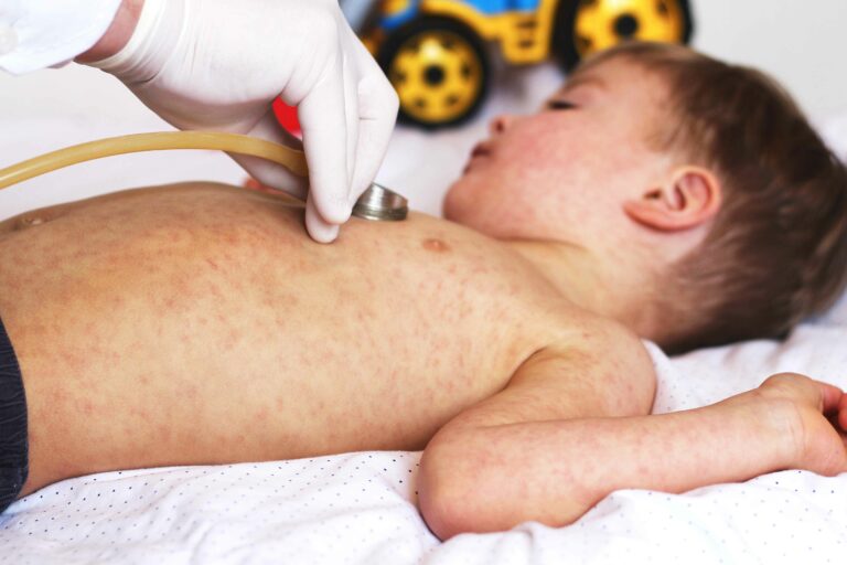 Parents warned over 21-day isolation for children without measles jab